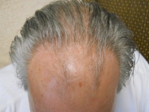 Hair Loss: Organs possibly involved are kidneys, lungs, and liver.