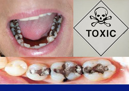 Amalgams Are Silver Or Black Fillings That Are Half Toxic Mercury