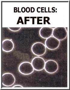 Detox Foot Bath Scam? Absolutely not if you are using actual medical equipment. These blood cells from after the detox foot bath help prove it!