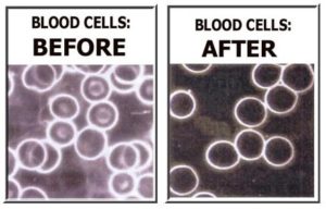 Dark microscopy pictures of blood cells - BEFORE and AFTER
