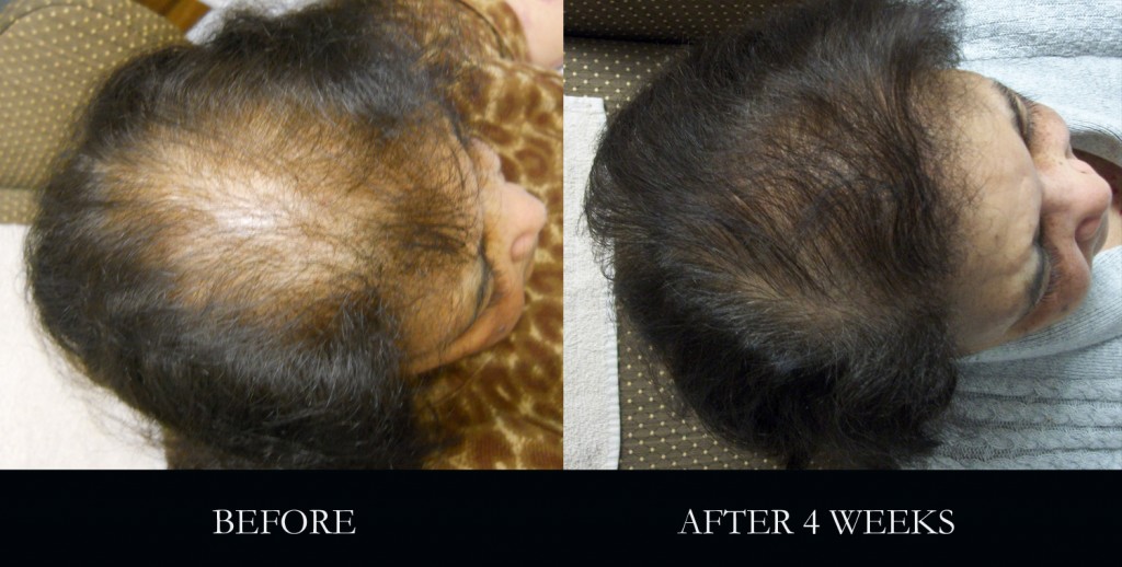 Alopecia: How to regrow thinning hair.