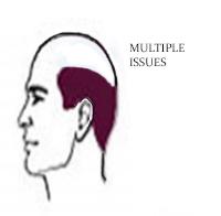 HAIR-LOSS-PATTERNS-MULTIPLE ISSUES