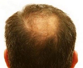 Male Pattern Baldness: Protein Digestion