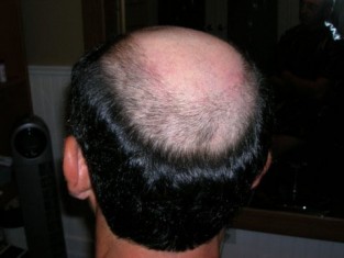 Hair Loss: