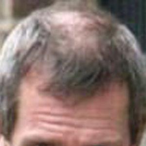 HAIR-LOSS-PATTERNS-circulatory