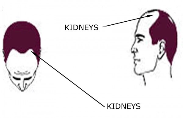 HAIR LOSS PATTERNS - kidneys