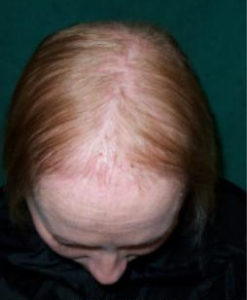 Hair Loss Pattern: Organ Issues And Thin All Over