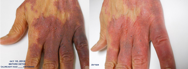 Hand before and after detox oct 10 2012 gloria k website