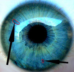 Blue Iris with Iridiology Markings