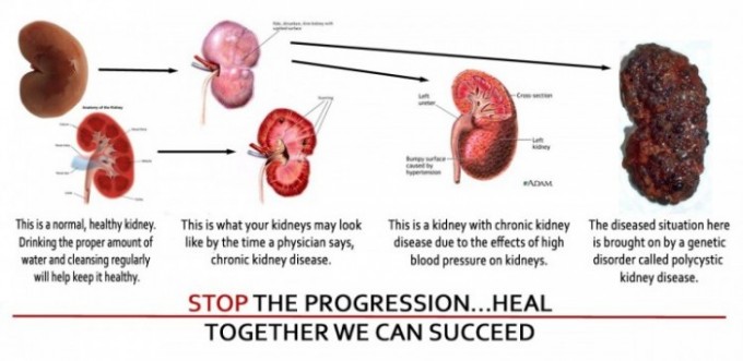 Kidney Failure, Progression