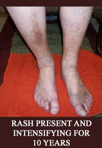 METAL TOXICITY RASH ON LEGS FOR 10 YEARS