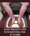 METAL TOXICITY RASH ON LEGS FOR 35 YEARS