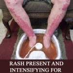 METAL TOXICITY RASH ON LEGS FOR 35 YEARS