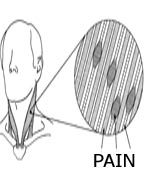 PAIN IN MUSCLE FIBERS