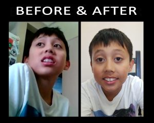 AUTISM: Patrick's Before & Ater