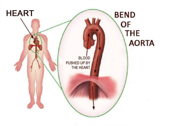 Hypertension: Bend of the Aorta