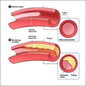 Cholesterol in arteries with labels