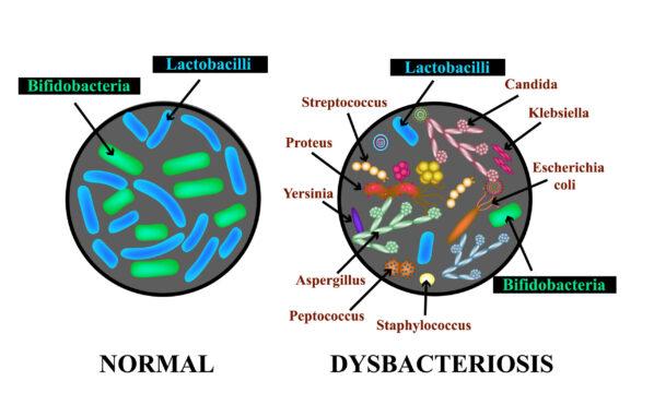 Dysbacteriosis of the intestine. Lactobacillus, Bifidobacteria, Streptococcus, Staphylococcus, E. coli, Aspergyllus mushrooms, Candida. Infographics. 