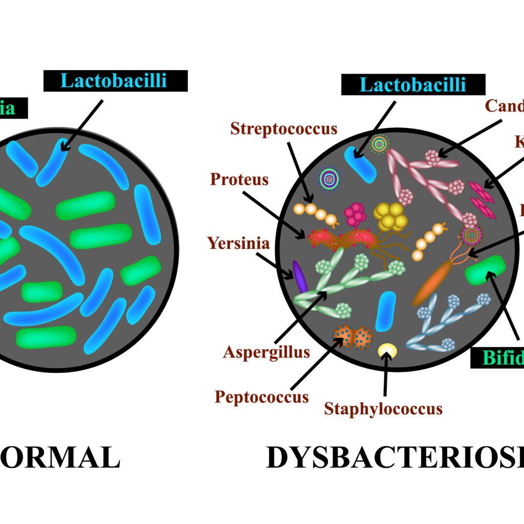 Dysbacteriosis of the intestine. Lactobacillus, Bifidobacteria, Streptococcus, Staphylococcus, E. coli, Aspergyllus mushrooms, Candida. Infographics.