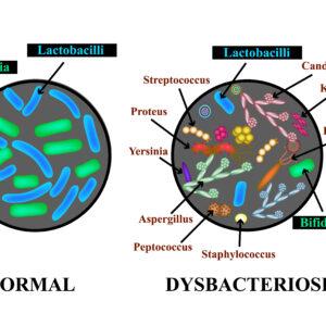 Dysbacteriosis of the intestine. Lactobacillus, Bifidobacteria, Streptococcus, Staphylococcus, E. coli, Aspergyllus mushrooms, Candida. Infographics.