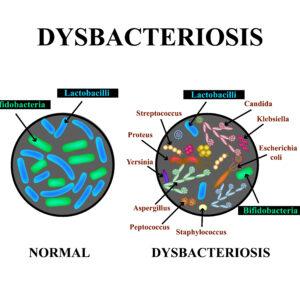 Dysbacteriosis of the intestine. Lactobacillus, Bifidobacteria, Streptococcus, Staphylococcus, E. coli, Aspergyllus mushrooms, Candida. Infographics.