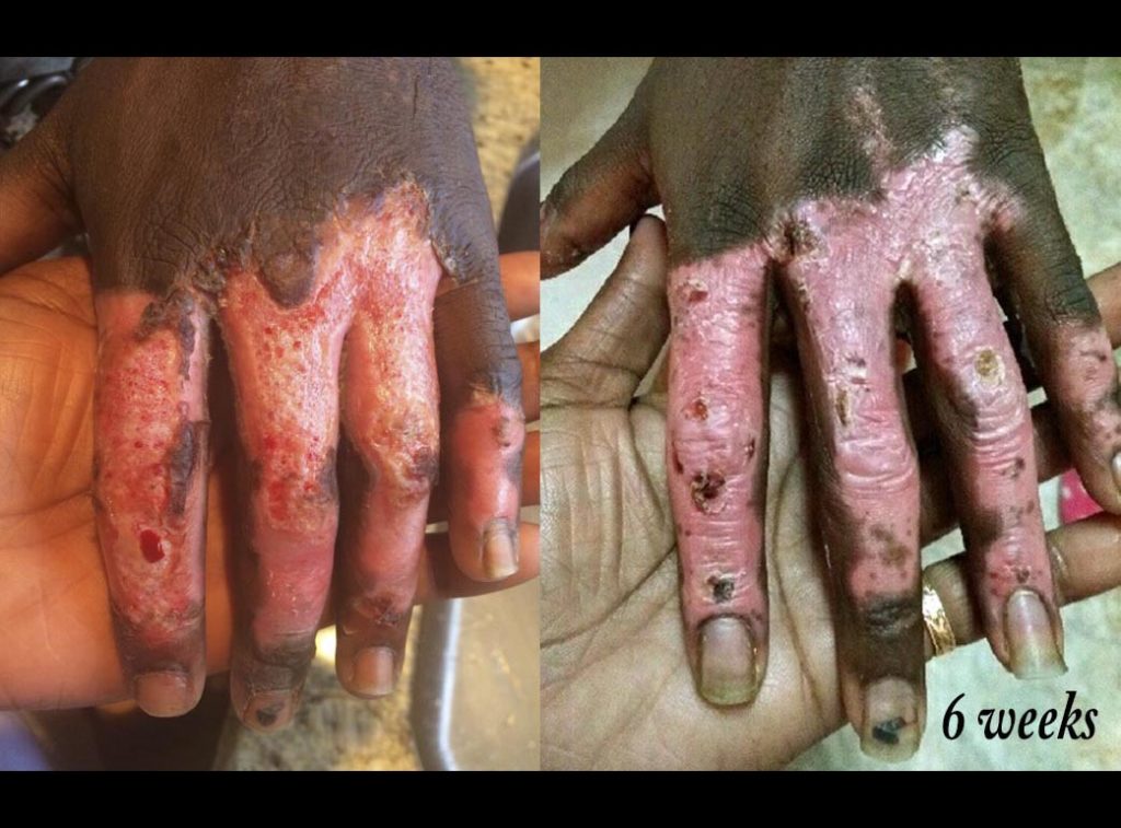 Burnt Hand Healing
