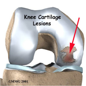 Joint damage - isteoarthritis