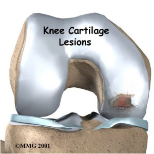 joint - osteoarthritis earlier stage