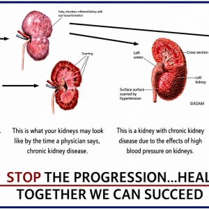 The pictorial progression of kidney problems.