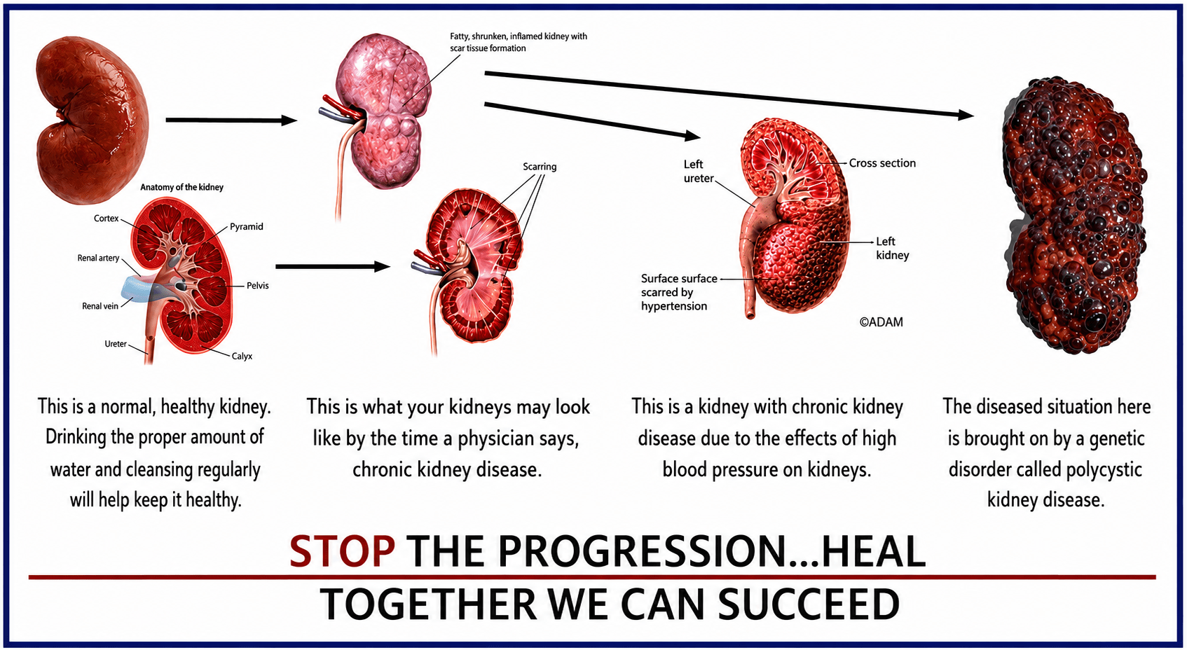 The pictorial progression of kidney problems.