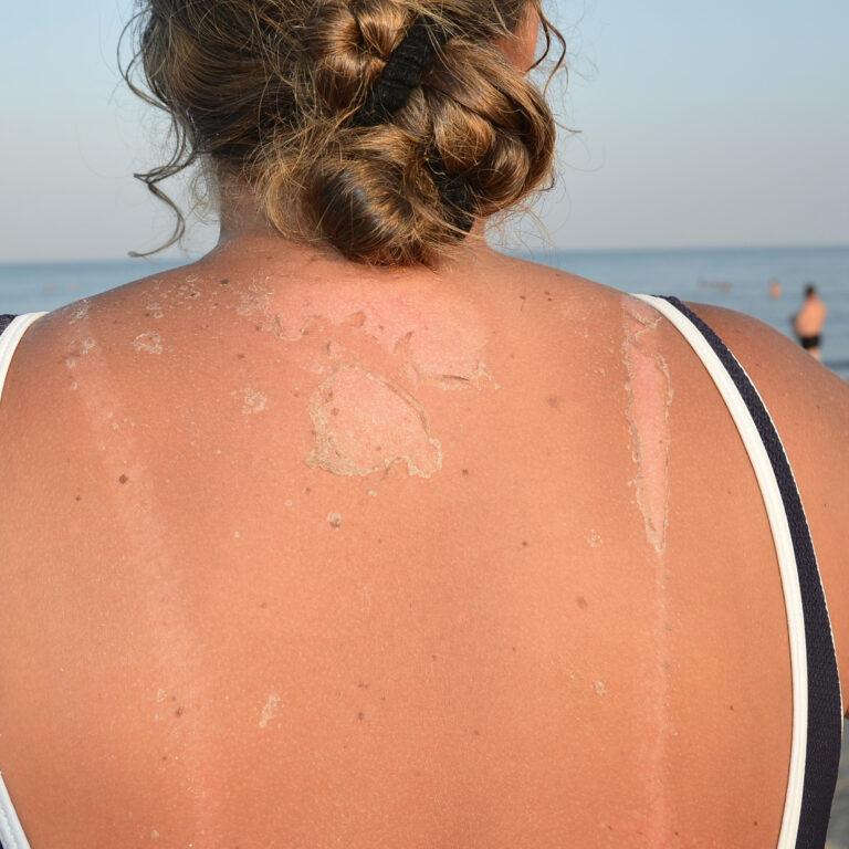 Sunburn Relief for Summertime