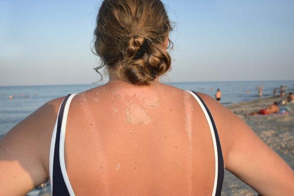 sunburned back
