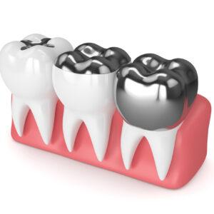 Teeth with different types of dental amalgam filling containing mercury.