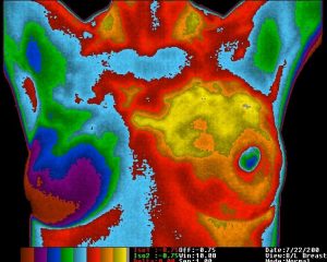 Thermal Imaging: Breast and Neck